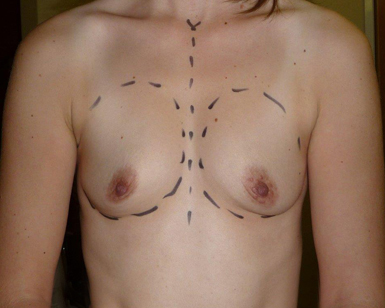 Breast Enlargement Before and After Picture
